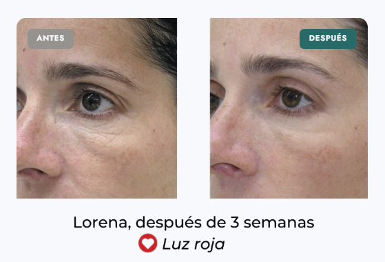 DISMINUCIÓN DE LÍNEAS DE EXPRESIÓN