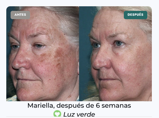 DISMINUCIÓN DE LÍNEAS DE EXPRESIÓN